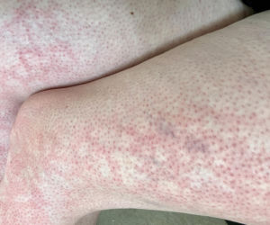 Masz taką siateczkę na nogach? Jeden szczegół zdradza, czy to tylko zimno, czy poważna choroba