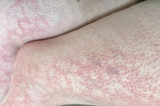 Masz taką siateczkę na nogach? Jeden szczegół zdradza, czy to tylko zimno, czy poważna choroba