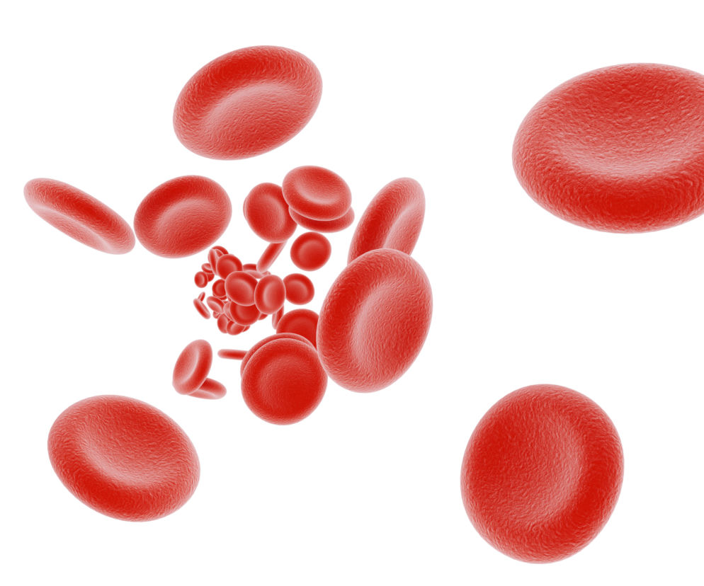 Napadowa nocna hemoglobinuria - przyczyny, objawy, skutki i powikłania