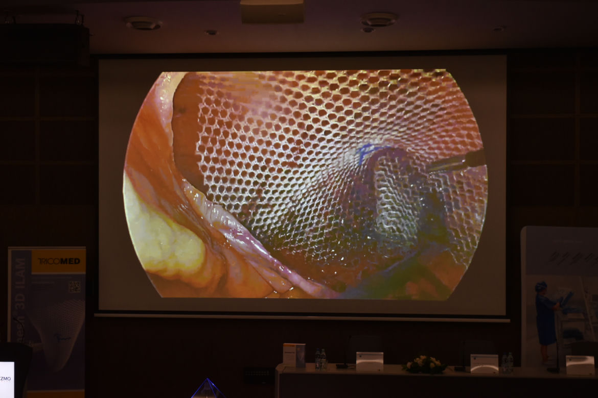 Profesor Maciej Śmietański po raz pierwszy na świecie wszczepił implant Optomesh 3D ILAM. Dokonał tego w Toruniu