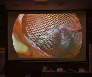 Profesor Maciej Śmietański po raz pierwszy na świecie wszczepił implant Optomesh 3D ILAM. Dokonał tego w Toruniu