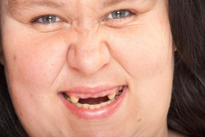Brakuje ci zębów? To może wpływać na wagę. Dentystka tłumaczy mechanizm