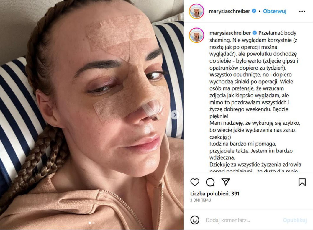 Tak wygląda Marianna Schreiber po operacji nosa