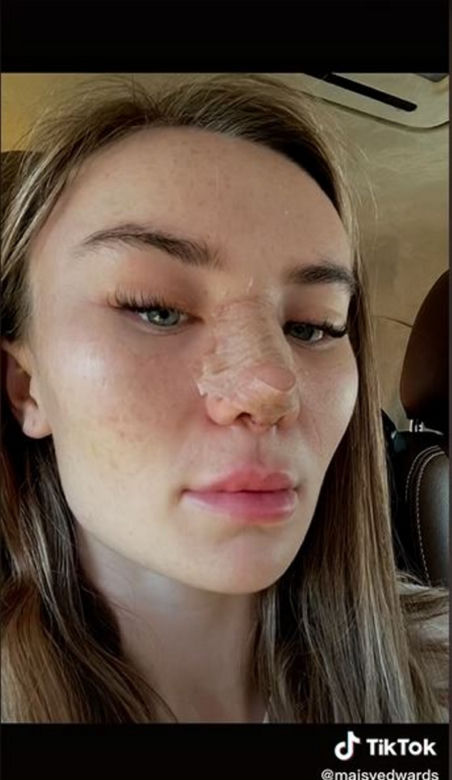 Znana influencerka pojechała do Turcji "zrobić" sobie nos. Wydała 50 tys. zł, fani bezlitośni: "Jest gorzej"
