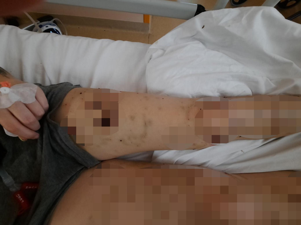 Sfora psów pogryzła 18-latkę pod Łaskiem. Ich właściciel nie przyznaje się do winy [ZDJĘCIA]. 