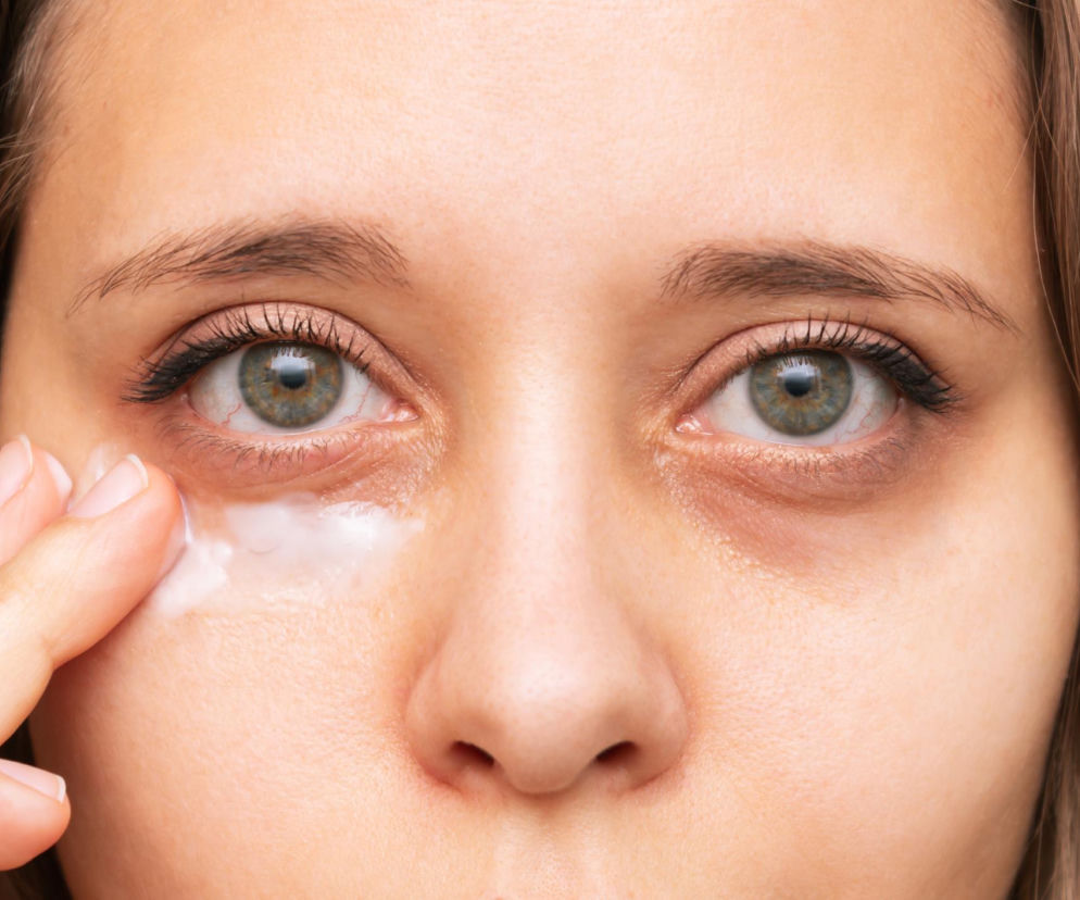 Kobieta z widocznymi workami pod oczami, nakładająca krem pod prawe oko. Zdjęcie ilustruje problem opuchlizny wokół oczu, który nie zawsze jest związany ze zmęczeniem, ale może być objawem poważnych chorób, o czym przeczytasz na Poradnik Zdrowie.