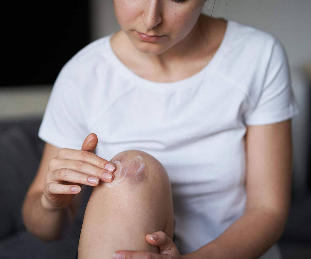 Kobieta w białej koszulce nakłada krem na widoczny siniak na kolanie. To symboliczne przedstawienie problemu łatwego siniaczenia, które może być sygnałem kruchości naczyń krwionośnych lub niedoborów witamin. Więcej o ukrytych przyczynach siniaków przeczytasz na Poradnik Zdrowie.