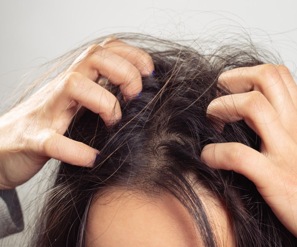 Dwie kobiece dłonie z ciemnym lakierem na paznokciach, drapiące swędzącą skórę głowy z widocznym łupieżem. Zdjęcie ilustruje problem uporczywego swędzenia i poszukiwania jego przyczyn, o czym więcej przeczytasz na Poradnik Zdrowie.