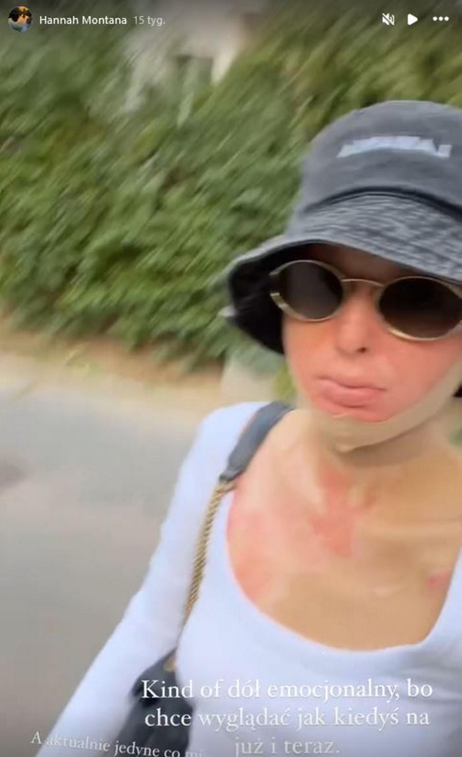 Maja Kuczyńska przeżyła piekło. Całe ciało w oparzeniach