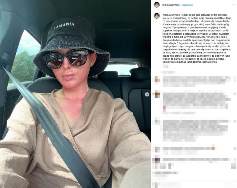 Maja Kuczyńska przeżyła piekło. Całe ciało w oparzeniach