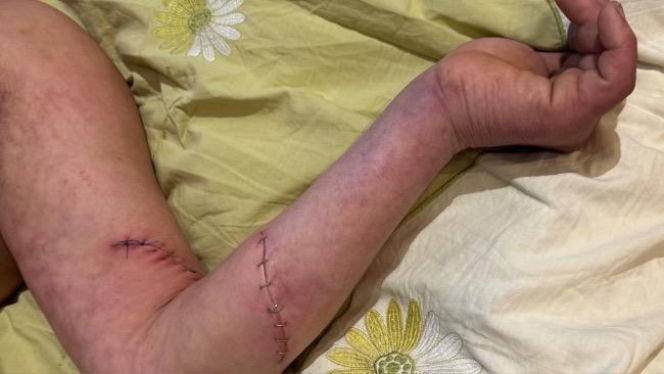 Stanął w obronie kobiety, skatowali go maczetami. Piotrek ledwo przeżył. "Niemal mnie zabili"