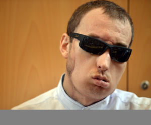 przeszczep twarzy pacjent wyszedl do domu (3a)