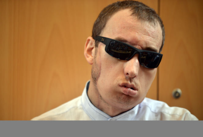 przeszczep twarzy pacjent wyszedl do domu (3a)