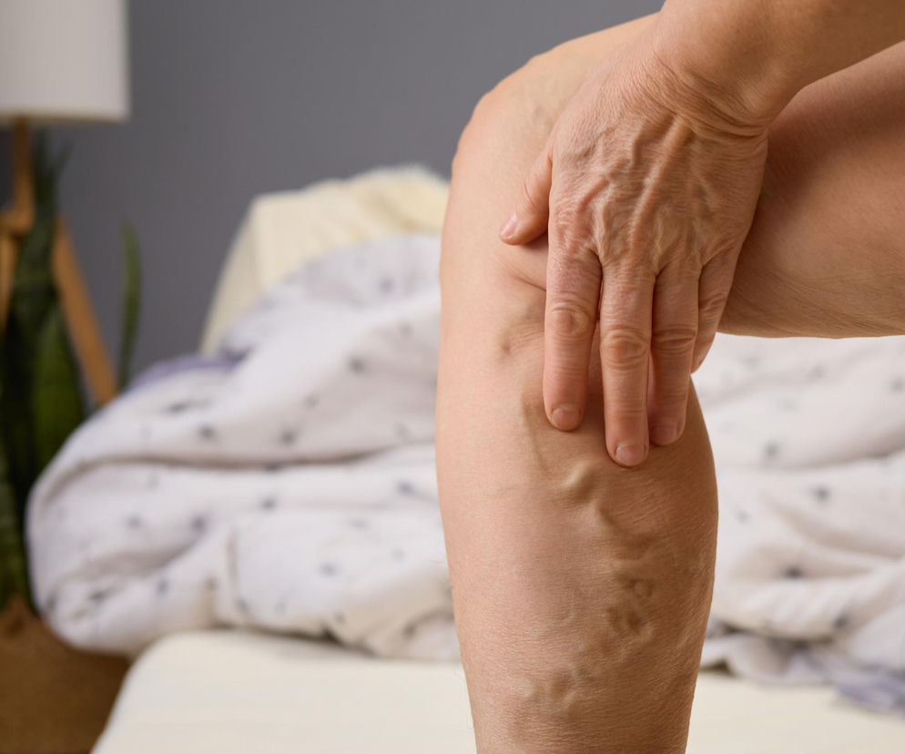 Noga osoby z widocznymi żylakami i powiększonymi naczyniami krwionośnymi, dłoń dotyka łydki. Zdjęcie ilustruje problem zdrowotny, o którym można przeczytać na portalu Poradnik Zdrowie.