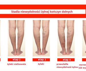 Żylaki