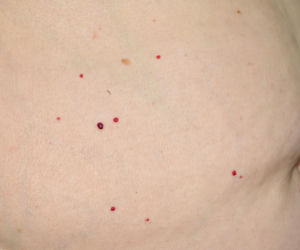 Masz na skórze małe czerwone punkciki? Większość osób ignoruje punkty De Morgana, ale jeden objaw powinien zaniepokoić