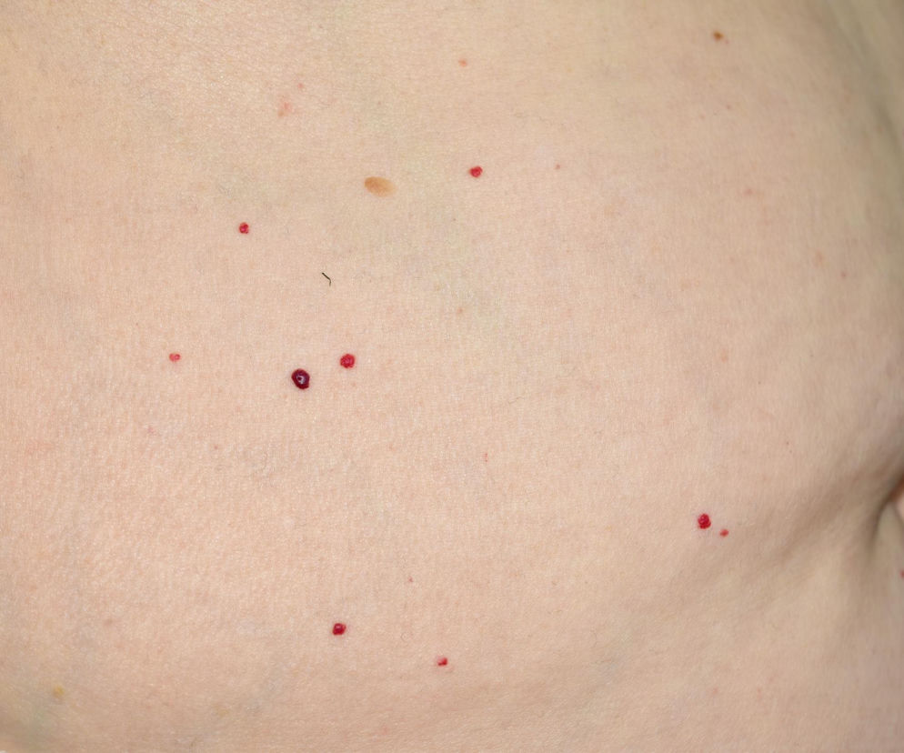 Masz na skórze małe czerwone punkciki? Większość osób ignoruje punkty De Morgana, ale jeden objaw powinien zaniepokoić