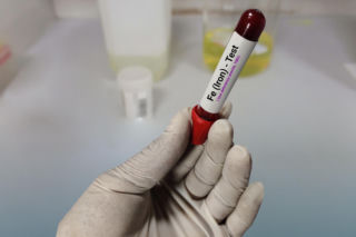 Nietypowy objaw niedoboru żelaza. Lekarze mówią wprost, kiedy trzeba zbadać krew