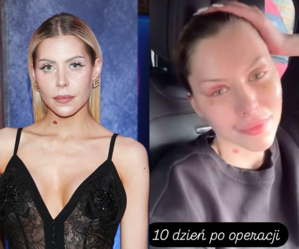 Julia von Stein na dwóch zdjęciach. Obok fotka z napisem: 10 dzień po operacji. O sporze z lekarzem przeczytasz na SE.