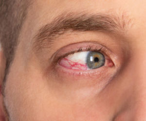 Wylew krwi do oka. Kiedy ten niepokojący objaw świadczy o poważnej chorobie?