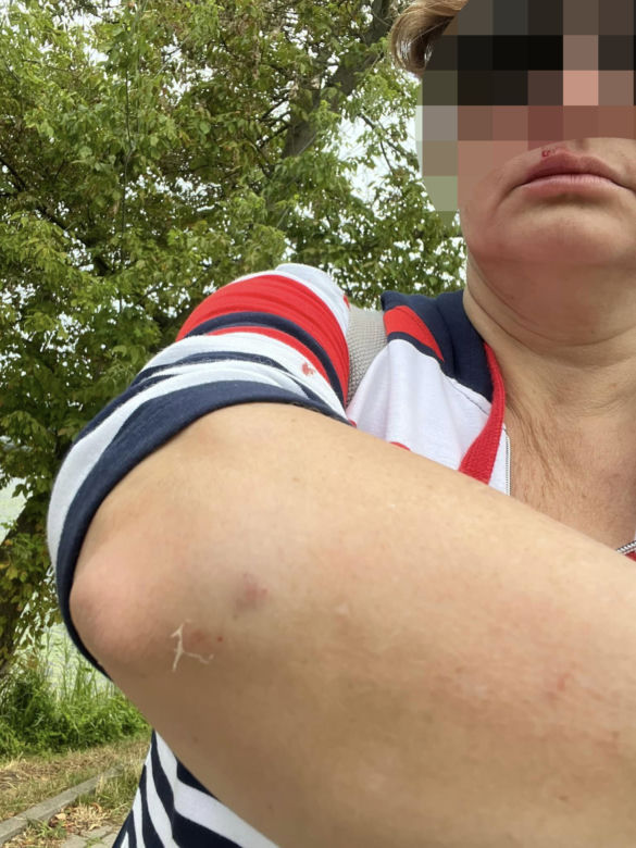 Kobieta pobita przez staruszka, bo zwróciła mu uwagę. "Przewrócił mnie na chodnik i okładał parasolką, potem uderzył pięścią w twarz"