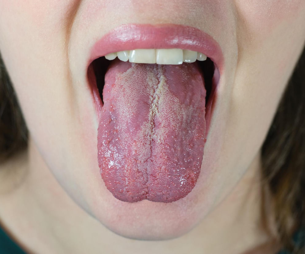 Język osoby z nalotem, widocznym jako białe lub żółtawe plamy na języku, może wskazywać na obecność grzyba Candida albicans, który, jak informuje Poradnik Zdrowie, może zwiększać agresywność czerniaka, najniebezpieczniejszego nowotworu skóry.