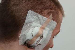 Kamil z Krakowa po latach walki ma nowe ucho. Nikt na świecie nie chciał się podjąć operacji