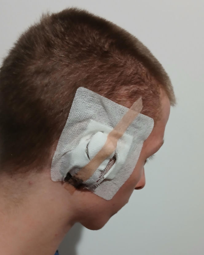 Kamil z Krakowa po latach walki ma nowe ucho. Nikt na świecie nie chciał się podjąć operacji