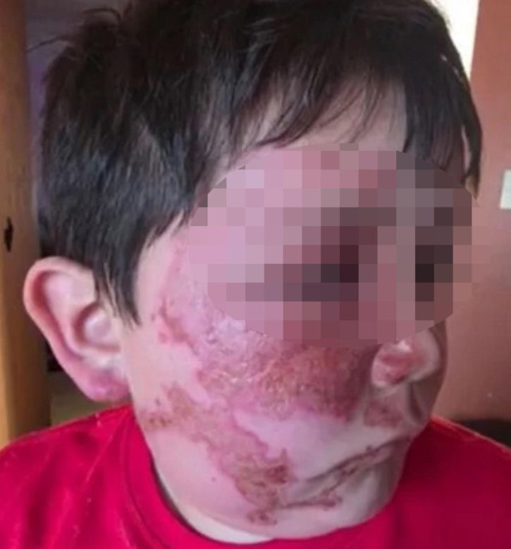Wsadził do mikrofali plastik, eksplodował mu na twarz. 9-latek oszpecony na zawsze. Nowy niebezpieczny trend