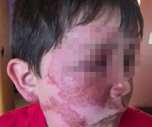 Wsadził do mikrofali plastik, eksplodował mu na twarz. 9-latek oszpecony na zawsze. Nowy niebezpieczny trend