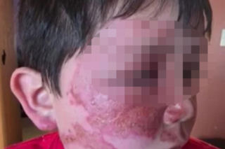 Wsadził do mikrofali plastik, eksplodował mu na twarz. 9-latek oszpecony na zawsze. Nowy niebezpieczny trend