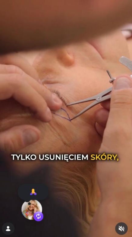 Agata Młynarska zrobiła sobie powieki! Wszystko pokazała na Instagramie. Na efekt operacji trzeba trochę zaczekać