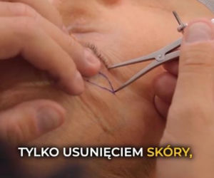 Agata Młynarska zrobiła sobie powieki! Wszystko pokazała na Instagramie. Na efekt operacji trzeba trochę zaczekać