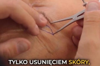 Agata Młynarska zrobiła sobie powieki! Wszystko pokazała na Instagramie. Na efekt operacji trzeba trochę zaczekać