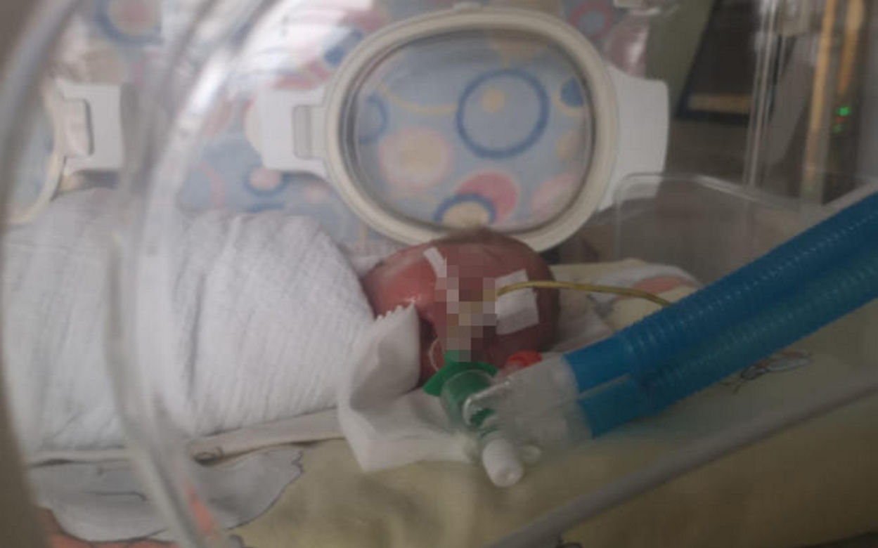 Siostry rozdzielone tuż po porodzie. Lekarze nie mieli innego wyjścia. Rodzice dziewczynek nie chcą się poddać [ZDJĘCIA]
