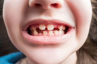 Krzywe zęby u dziecka? Zwróć uwagę, co jego język robi w spoczynku