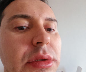 Michał Witkowski wstrzykuje sobie botoks i powiększa usta!