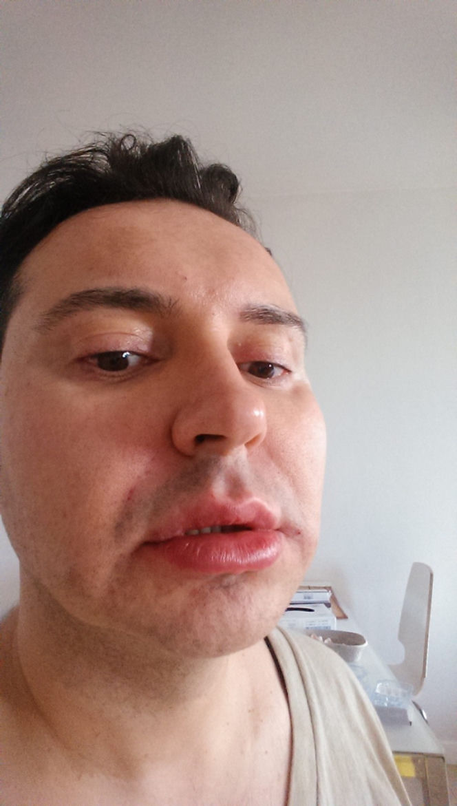 Michał Witkowski wstrzykuje sobie botoks i powiększa usta!
