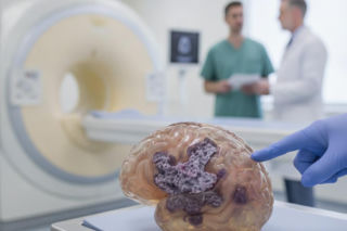 Te objawy mogą sygnalizować glejaka. Wymagają pilnej diagnostyki
