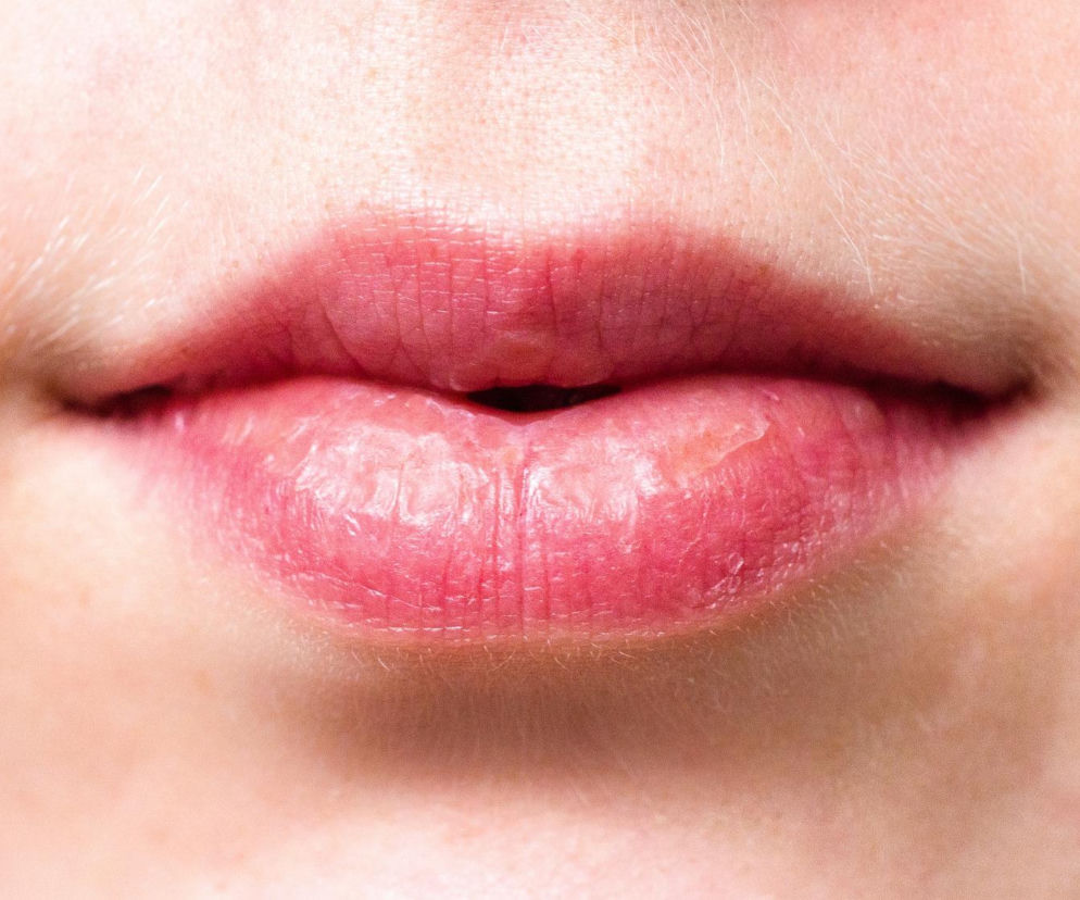 Spierzchnięte, wysuszone usta o jasnoróżowej barwie z widocznymi pęknięciami i fragmentami suchej skóry. Wokół warg delikatny meszek. Na Poradniku Zdrowie znajdziesz wskazówki, jak zapobiegać problemom ze spierzchniętymi ustami zimą.