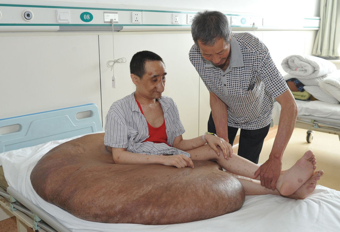 Mężczyzna z gigantycznym guzem! Narośl ważyła 107 kilogramów!