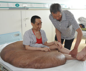 Mężczyzna z gigantycznym guzem! Narośl ważyła 107 kilogramów!