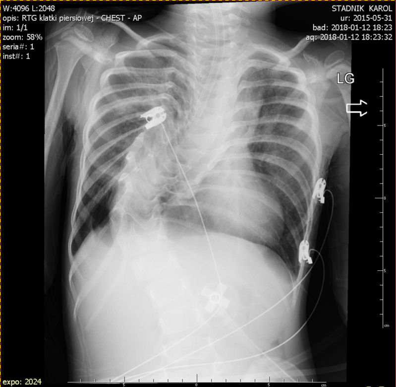 KAROLEK IMPLANT KRTANI WADA KRĘGOSŁUPA