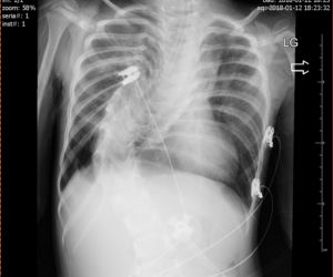 KAROLEK IMPLANT KRTANI WADA KRĘGOSŁUPA