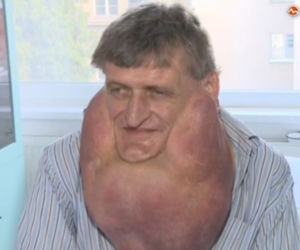 dzięki lekarzom odzyskał twarz!
