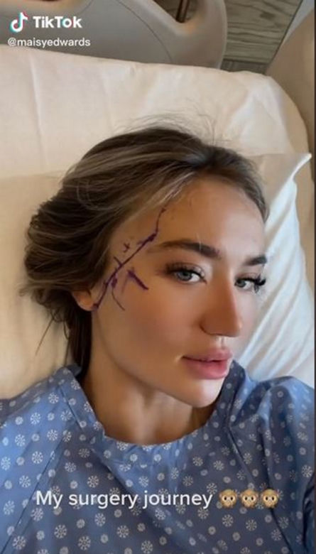 Znana influencerka pojechała do Turcji "zrobić" sobie nos. Wydała 50 tys. zł, fani bezlitośni: "Jest gorzej"
