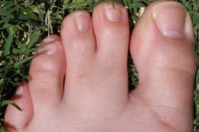 SYNDAKTYLIA 
