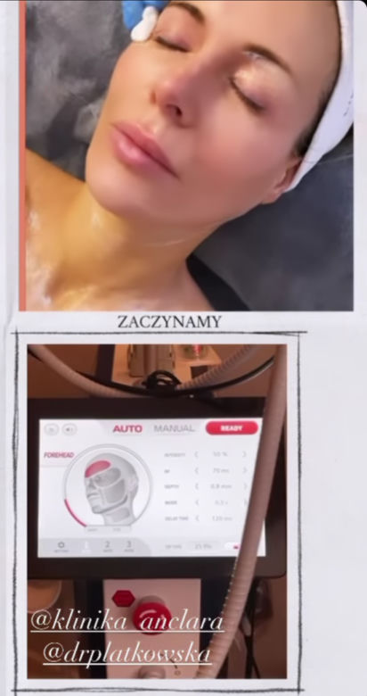 Rozenek razi twarz prądem