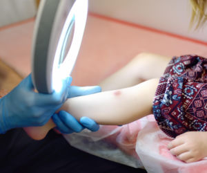 Rodzice często mylą je z pieprzykami. Te plamki mogą wymagać pilnej kontroli