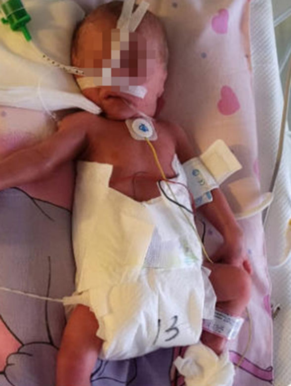 Siostry rozdzielone tuż po porodzie. Lekarze nie mieli innego wyjścia. Rodzice dziewczynek nie chcą się poddać [ZDJĘCIA]